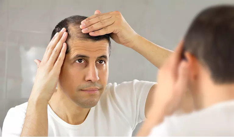 male pattern baldness