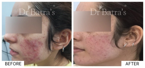 Acne Types