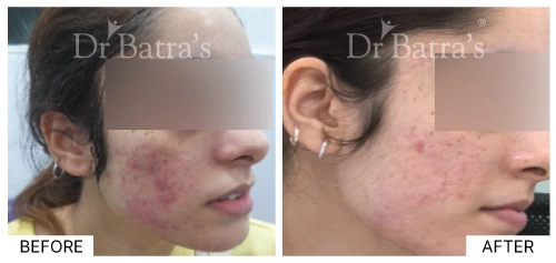 Acne Types