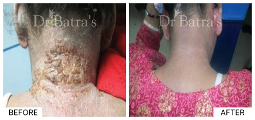 Eczema symptom showing red, itchy rash on the patient's skin | Dr. Batra's