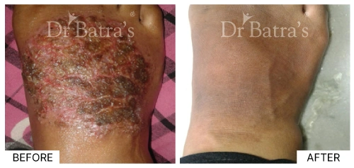 Patient's skin with eczema symptoms showing severe irritation | Dr. Batra's