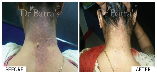 Eczema symptom displaying rough patches of skin | Dr. Batra's