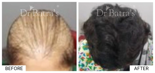 Female pattern baldness causes showing hair thinning on the top of a woman's scalp | Dr. Batra's
