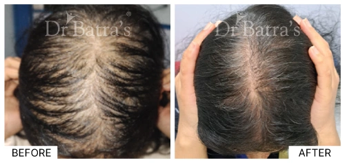 Patient experiencing hair loss due to female pattern baldness | Dr. Batra's