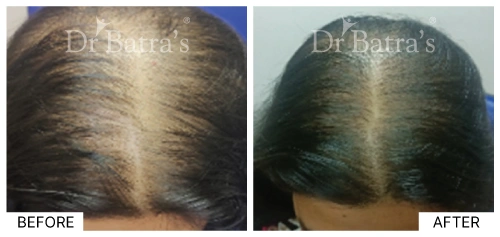 Close-up of hair thinning on the crown of a woman’s head caused by female pattern baldness | Dr. Batra's