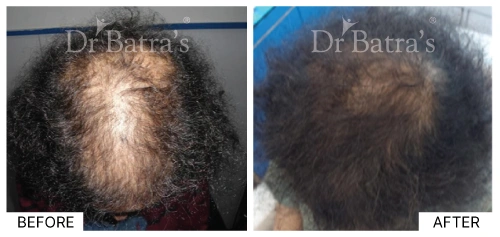 Hair thinning on a woman’s scalp due to female pattern baldness | Dr. Batra's