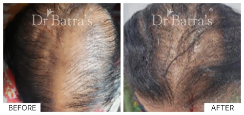 Hair loss types