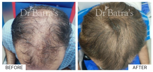 Hair loss types