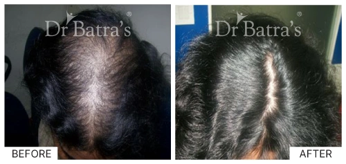 Hair loss types