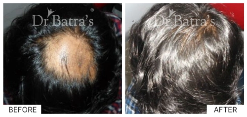 Hair loss types
