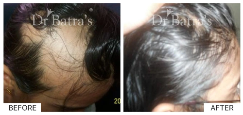 Hair loss types