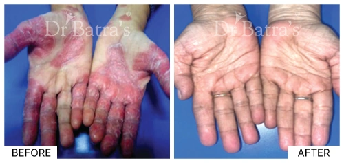 Patient 1 exhibiting classic symptoms of psoriasis with red, scaly patches | Dr. Batra's