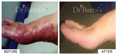 Patient 2 showing localized psoriasis lesions with silvery scales | Dr. Batra's