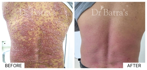 Patient 3 illustrating common psoriasis symptoms with inflammation | Dr. Batra's