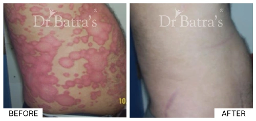 Patient 4 presenting symptoms of psoriasis characterized by flaking skin | Dr. Batra's