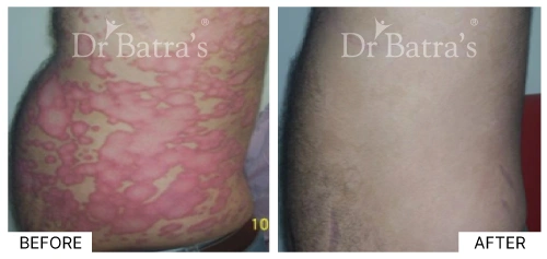 Patient 5 revealing signs of psoriasis with noticeable skin irritation | Dr. Batra's