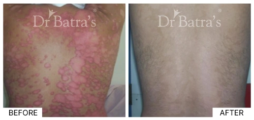 Patient 6 showing a severe case of psoriasis with prominent redness | Dr. Batra's