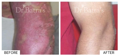 Patient 7 depicting extensive scaling associated with psoriasis | Dr. Batra's