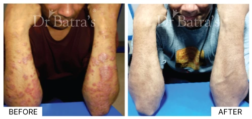 Patient 9 demonstrating various psoriasis symptoms on the skin | Dr. Batra's