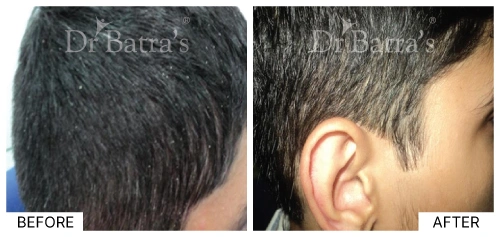 Seborrhoeic Dermatitis Causes