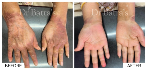 Causes of eczema showing dry, irritated skin on the patient's hand | Dr. Batra's