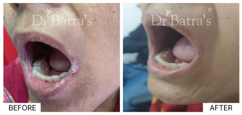 Causes of eczema linked to allergic reaction on the skin | Dr. Batra's