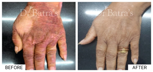 Patient showing skin inflammation as a cause of eczema | Dr. Batra's