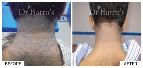 Eczema cause related to exposure to irritants, visible on the skin | Dr. Batra's