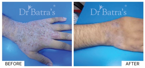 Dry patches on the skin caused by eczema | Dr. Batra's