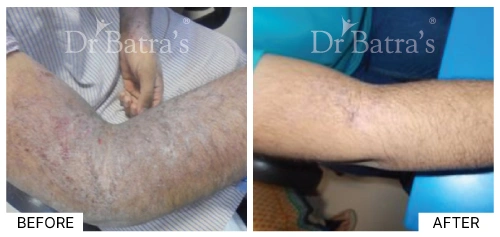 Eczema cause showing red, inflamed skin on the arm | Dr. Batra's
