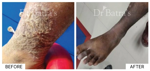 Environmental factor as a cause of eczema on the patient's skin | Dr. Batra's