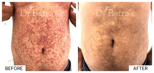 Image showing the underlying causes of psoriasis with inflamed skin | Dr. Batra's