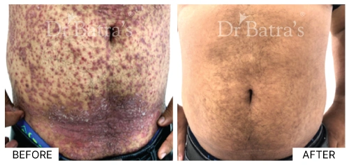 Illustration highlighting genetic factors contributing to psoriasis development | Dr. Batra's