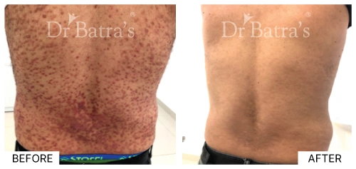 Diagram depicting environmental triggers associated with psoriasis flare-ups | Dr. Batra's