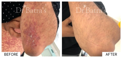 Visual representation of immune system response related to psoriasis | Dr. Batra's