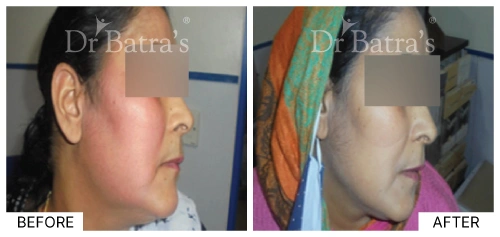 Patient showing skin affected by allergies, highlighting visible rashes and irritation | Dr. Batra's