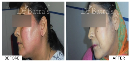 Patient's skin with allergy symptoms, showcasing redness and bumps | Dr. Batra's