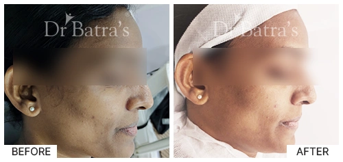 M Nitya Cured Skin 1