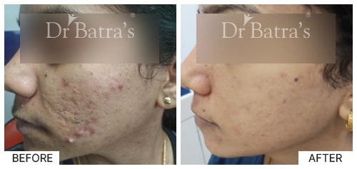 M Nitya Cured Skin 3