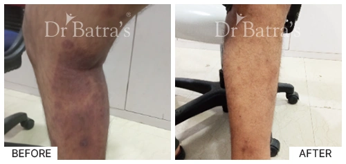 M Nitya Cured Skin 4