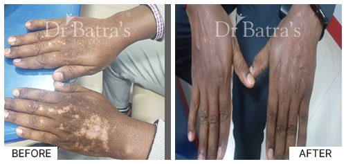 Marian Cured Skin 1