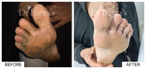 Nooreen Cured Skin 2