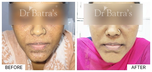 SheetalS Cured Skin 1