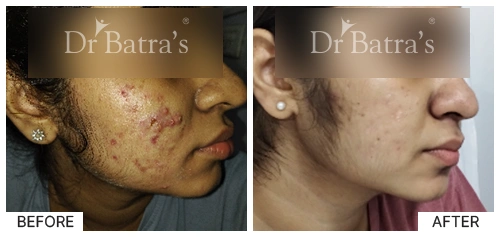 SheetalS Cured Skin 2