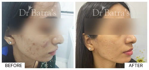 SheetalS Cured Skin 3