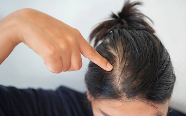 Is your hair loss just due to stress or there is some underlying disease causing it?