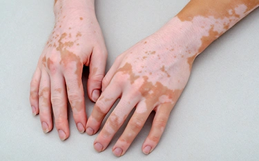 5 things to know about vitiligo disease