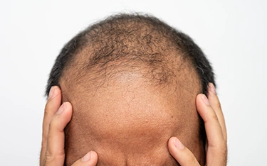 Can Alopecia Areata Turn Into Totalis?