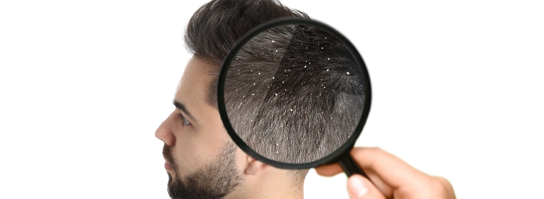 dandruff