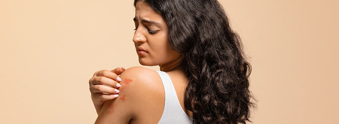 psoriasis